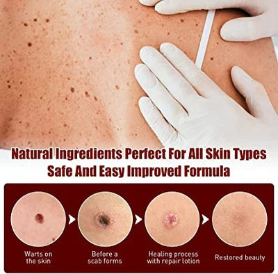 Natural skin care solution: Skin Tag & Mole Remover for wart treatment & blemish repair.