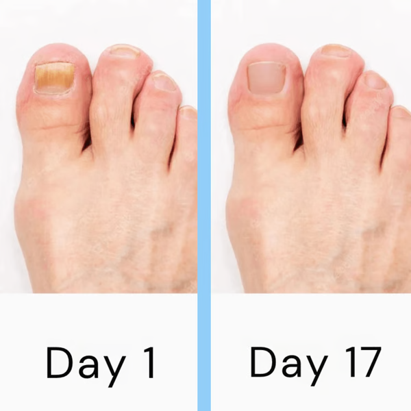 High-tech laser solution for nail fungus, promoting clear, strong, and healthy nails in your personal care routine.