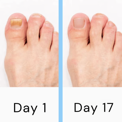 High-tech laser solution for nail fungus, promoting clear, strong, and healthy nails in your personal care routine.