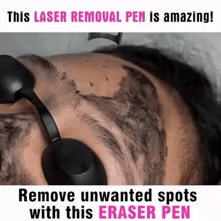 Handheld laser pen effectively removes unwanted tattoos & dark spots from skin at home.