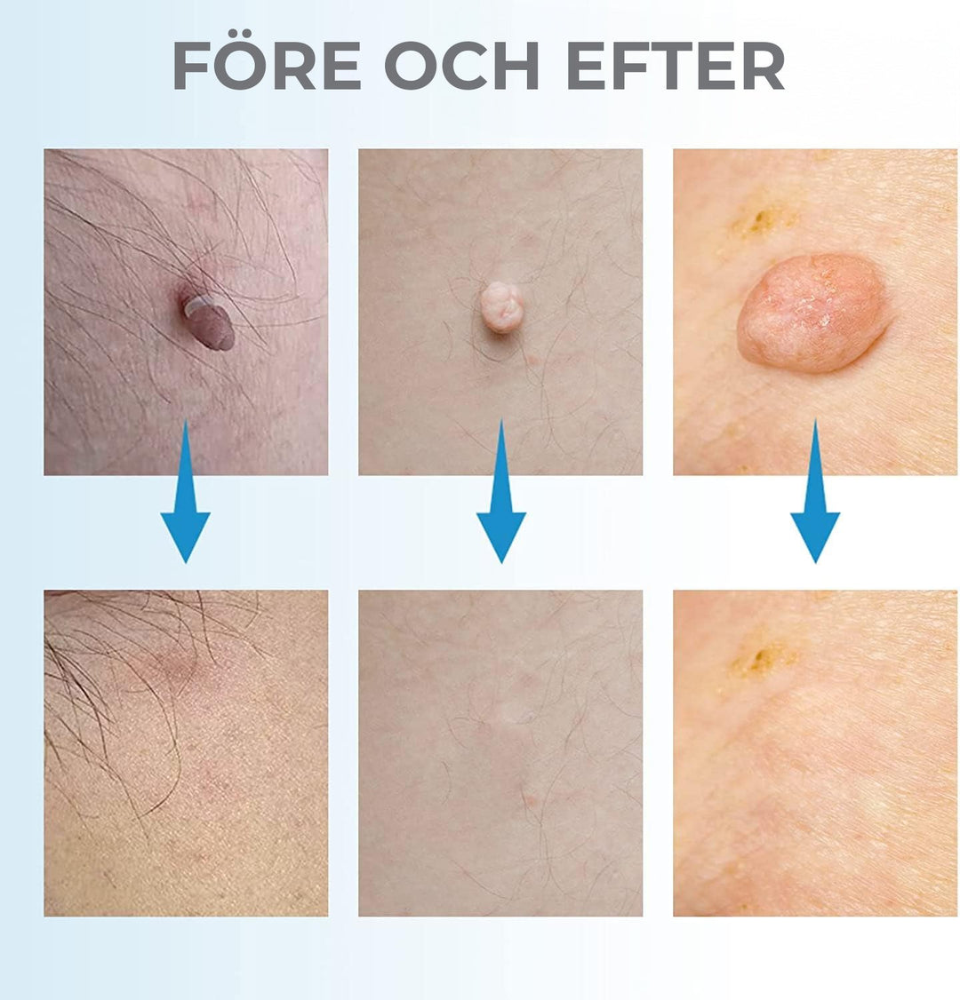Achieve clear skin with this at-home skin tag & mole removal kit. Easy, pain-free body treatment for imperfections.