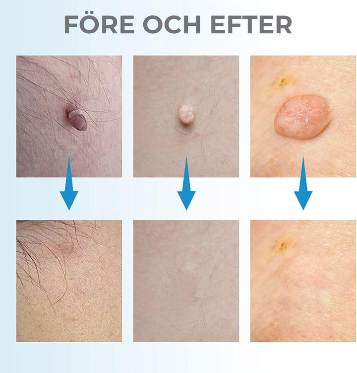 Achieve clear skin with this at-home skin tag & mole removal kit. Easy, pain-free body treatment for imperfections.