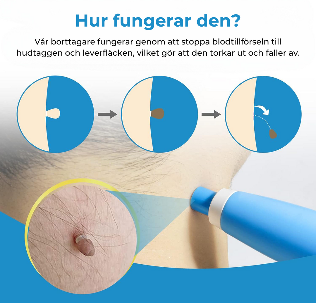 Complete at-home skin tag & mole remover kit for beauty & clear skin. Effective wart treatment & blemish solution.