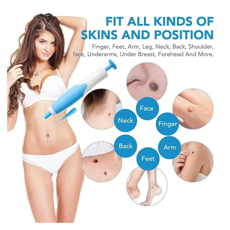 Complete skin tag removal kit using ligation method for fast, cosmetic blemish treatment at home.
