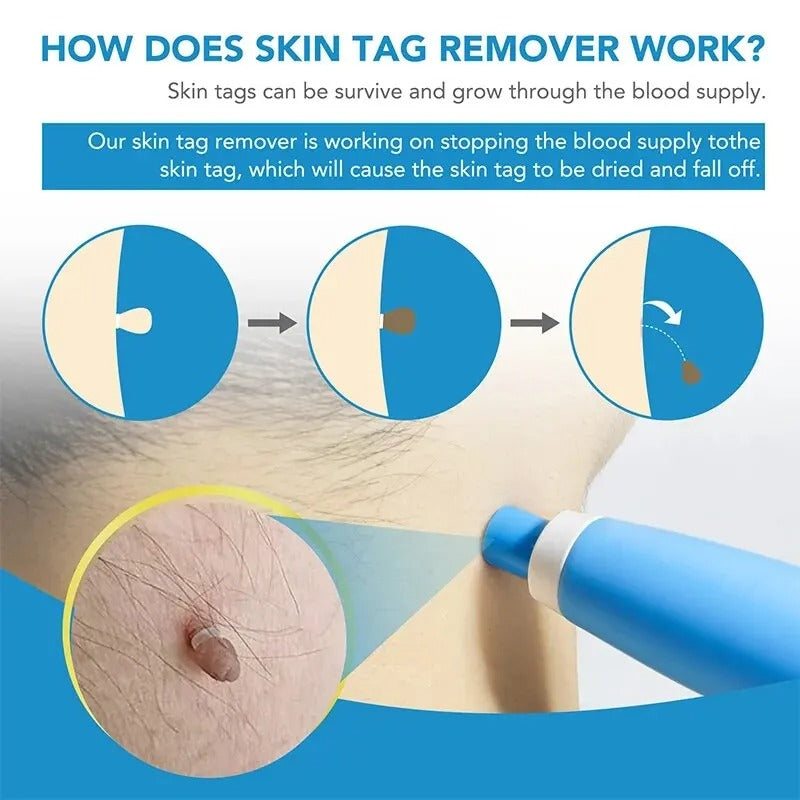 Achieve smooth, clear skin with this at-home skin tag removal kit, a painless solution for blemishes.