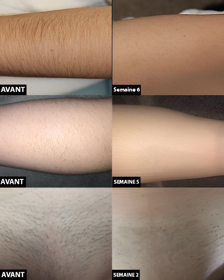 Women's personal care beauty device: At-Home Laser Hair Removal Handset for permanent, smooth results.