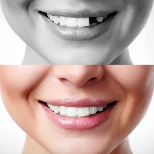 DIY moldable temporary false teeth kit for quick at-home dental repair & tooth replacement.