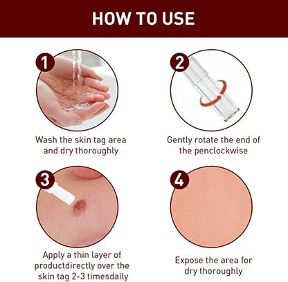 Home remedy skin tag and mole removal treatment for clear, blemish-free skin.