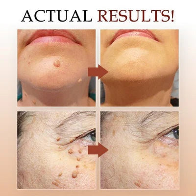 Achieve clear, healthy skin with this powerful skin tag & mole remover and wart treatment.