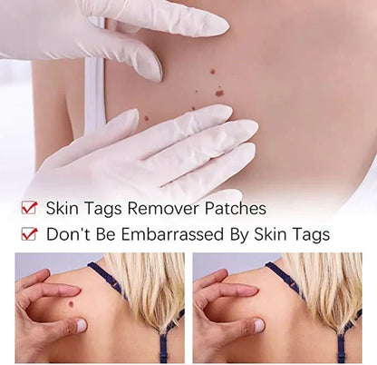 Gentle Skin Tag & Mole Remover with natural ingredients for effective blemish repair.