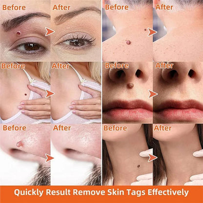 Effective auto skin tag remover kit for painless removal. Achieve clear, smooth skin with this easy-to-use home beauty tool.