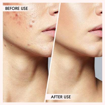 Complete skincare blemish tool kit for blackhead & pimple extraction. Achieve clear, smooth skin.
