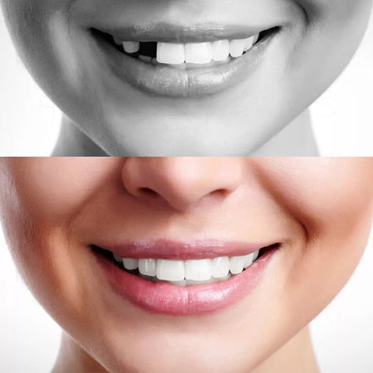 Temporary tooth repair kit with moldable false teeth for an instant smile & cosmetic fix.