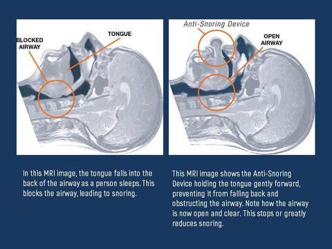 Unisex breathing aid: tongue stabilizer designed for sleep apnea relief & quiet, restorative sleep.