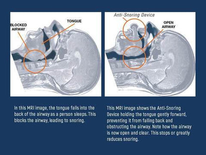 Unisex breathing aid: tongue stabilizer designed for sleep apnea relief & quiet, restorative sleep.