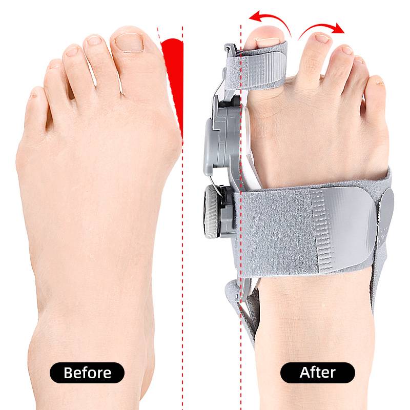 Unisex orthopedic bunion corrector with toe spacer for foot alignment. Non-surgical pain relief solution.