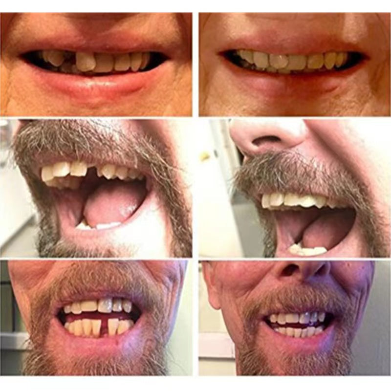 Natural-look temporary false teeth, a quick dental solution for a confident, instant smile. High-quality cosmetic veneers.